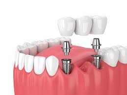Implants (Dental Implant Crown)